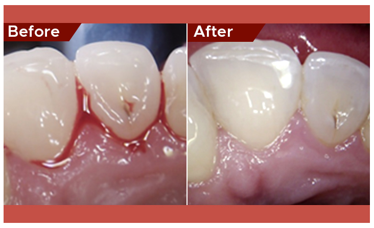 gum disease treatment in abu dhabi